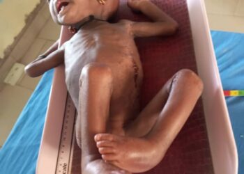 Taraba: Over 500 Children Battling Severe Acute Malnutrition, AVLPF Calls for Urgent Support