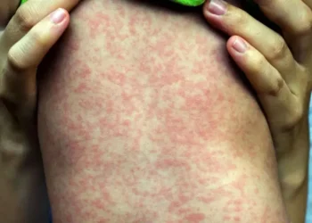 Measles Outbreak in U.S , Two Dead, Nearly 230 Infected