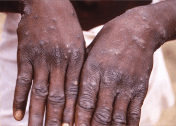 Africa Faces Cholera, Mpox, Other Health Emergencies Despite Increased Funding