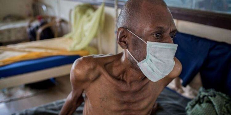 TB Cases Fall For First Time Since 2020, Says WHO