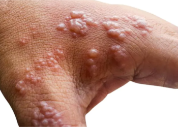 Africa CDC Reports New Mpox Surges in Madagascar, Comoros