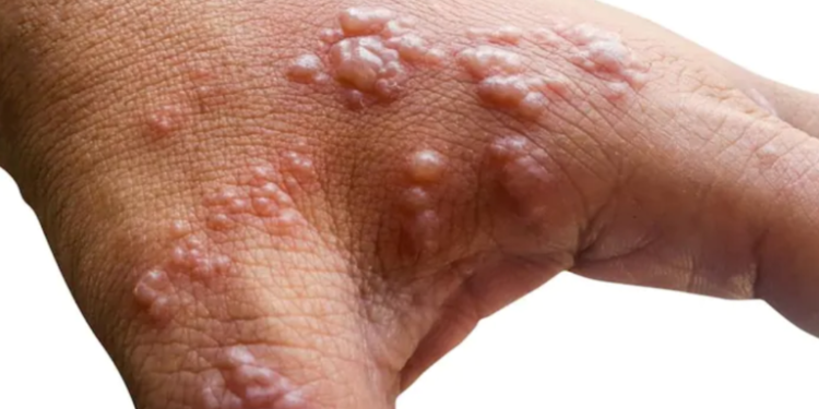 Africa CDC Reports New Mpox Surges in Madagascar, Comoros