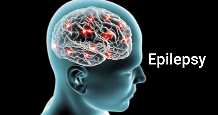 70% of Nigerians Living With Epilepsy Are Untreated, Neurological Scientists Say