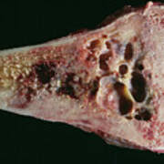 Bone Cancer Not a Death Sentence, Experts Stress Early Diagnosis